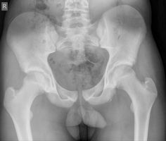 lobar pneumonia also known as a non segmental pneumonia or focal
