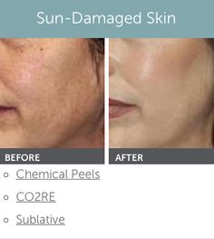 Valuable information Facial rejuvenation wyoming speaking, opinion Facial rejuvenation wyoming