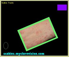 dalacin c clindamicina dalacin c and eskinol side effects