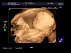 7 weken zwangere dating scan