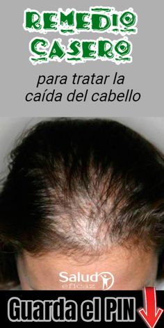 17 Ideas De Caida Cabello Remedios Caida Cabello Remedios Caída Del Cabello Remedios Para La Caída Del Cabello