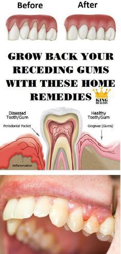 Oramd Original Strength In 2020 Gum Health Teeth Health Health Remedies