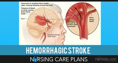 accidente cerebrovascular akibat diabetes accidente cerebrovascular akibat diabetes