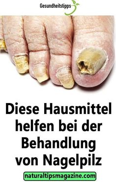 Nagelpilz Behandeln Wie Man Nagelpilz SCHNELL Behandelt Nagelpilz Behandeln Wie Man Nagelpilz SCHNELL Behandelt