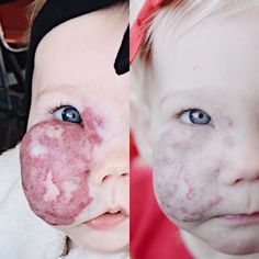 que es angioma wikipedia