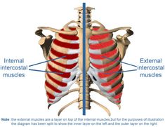 condritis intercostal
