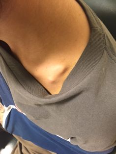 broken clavicle treatment broken clavicle treatment