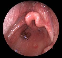 prostata hipertrofica cause of death