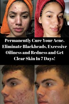 clear skin forever ebook free download Ebook free download forever clear skin