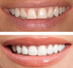 Does Cigna Insurance Cover Veneers
