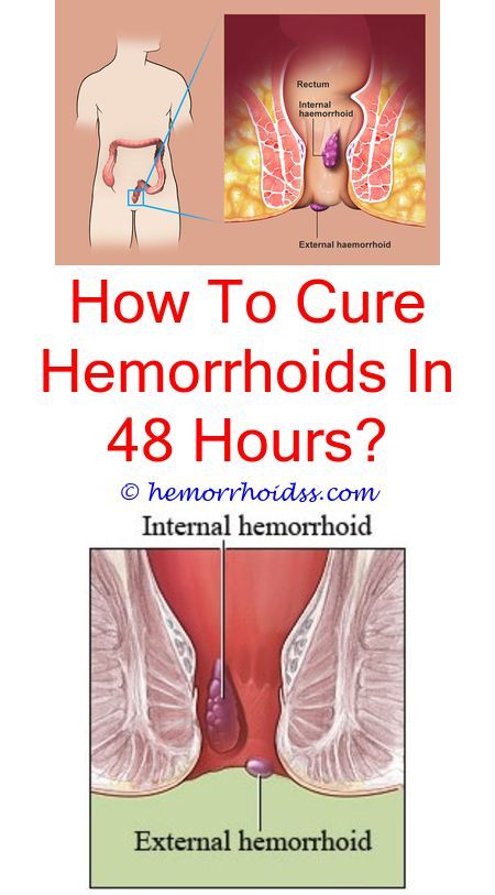 Can You Get Rid Of External Hemorrhoids Can You Feel A Hemorrhoid With Your Finger Can Witch Hazel Be Used For Internal Hemorrhoids What Shrinks External Hemorrhoids Can Suppositories For Bleeding Hemorrhoids Getting Rid Of Hemorrhoids Hemorrhoids Treatment