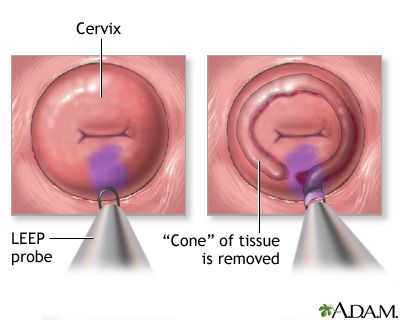 Cancer endometrial tratamiento, Human papillomavirus noknel