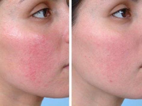 medicamentos para la rosacea cara