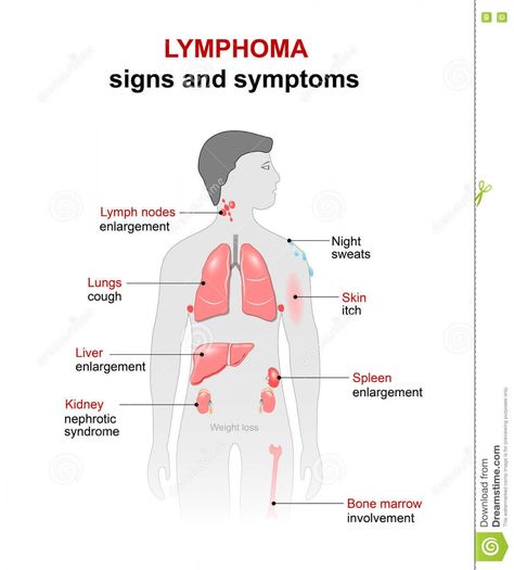 NHL | 's collection of 10+ hodgkins lymphoma ideas