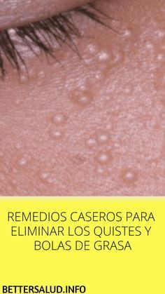 Elimina Los Granitos De La Frente Con Esta Mascarilla Natural En 2020 Remedios Caseros Para Granos Como Quitar Granos Remedios Para Granos Crema Casera Para Granos En La Cara