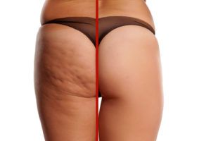 como eliminar celulitis en la barriga como eliminar celulitis en la barriga