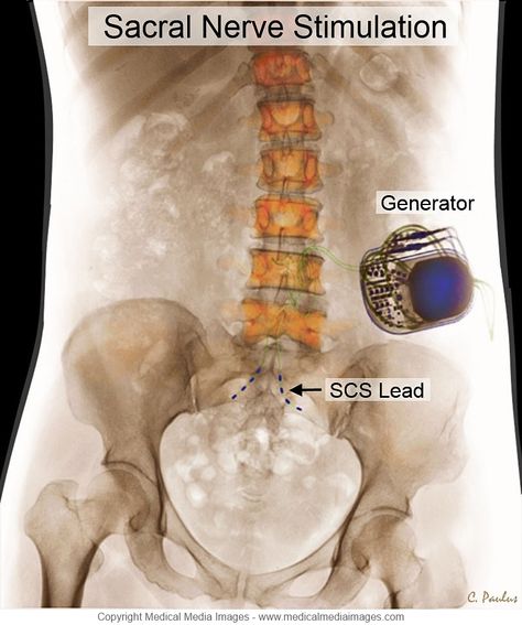 spinal cord stimulator gone wrong spinal cord stimulator gone wrong