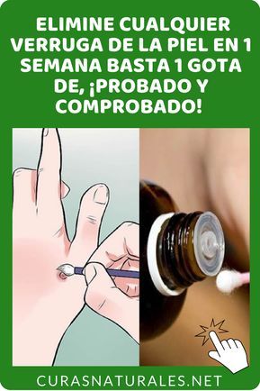 remedios para verrugas caseros