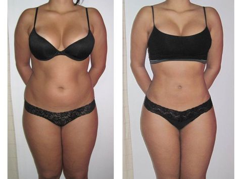 17 best i lipo bij slim concept images on pinterest liposuction i lipo works