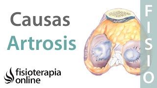 que produce la artrosis cervical