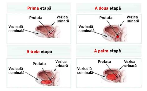 îmbunătățirea fluxului de urină cu prostatita