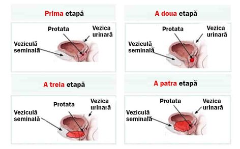 ceea ce poate provoca o exacerbare a prostatitei ieșire venoasă prostatită