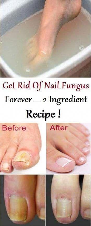 nail fungus kezelési tanács szakembere bojtorján köröm gomba kezelése