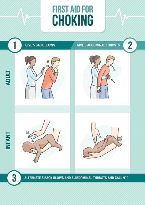 De heimlich en video maniobra ninos