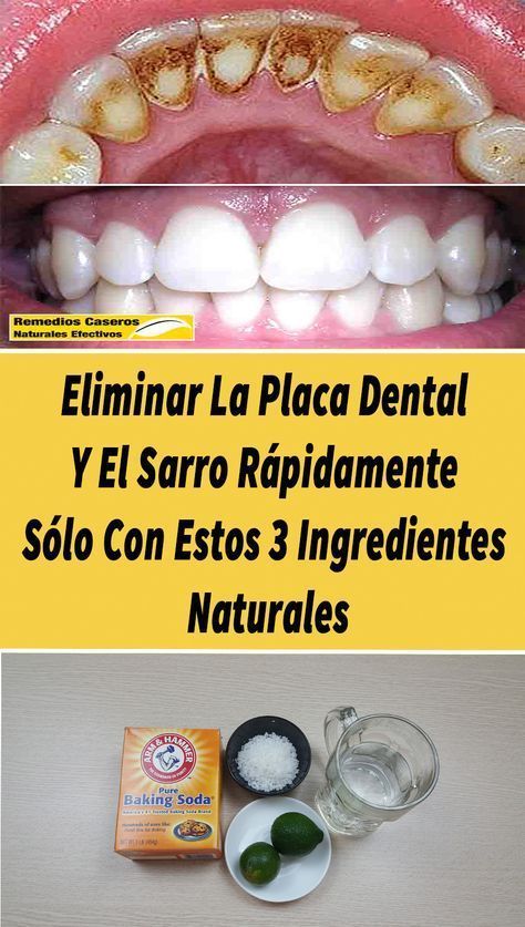 Using This Mouthwash Can Remove Dental Plaque And Tartar From Your Teeth It Also Reduces The Risk Of Gum Disease And Bad Breath How Remove Dental Gesundheit