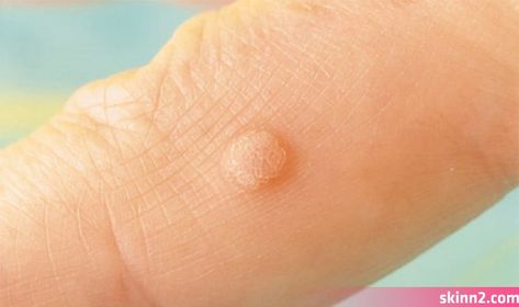 Las Mejores 20 Ideas De Verruga Plantar Verrugas Verruga Plantar Remedios