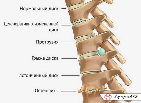 какие боли могут быть при артрозе плечевого сустава