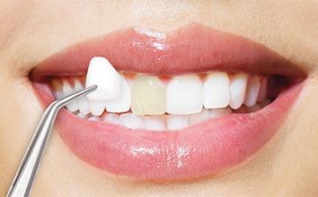 طبيب أسنان خطوات الصاق الفينير والزيركون الوجوه التجميلية In 2020 Veneers Laminate Porcelain