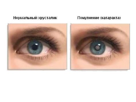 конопля лечение глаукомы конопля лечение глаукомы