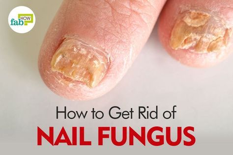 Can You Get Rid Of Toenail Fungus Permanently Remove The Fungus From Your Toenails With These Two Ingredients Toenails Toenailfungusremedies Toenail Fungus Remedies Skin Tags Home Remedies Toe Nails