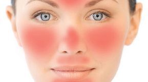 medicamentos para la rosacea cara