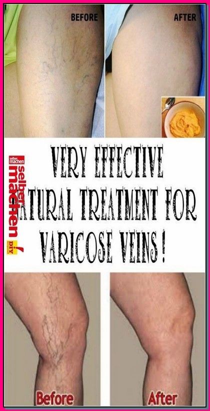 varicose picioare dieta chilot varicoza artemis recenzii