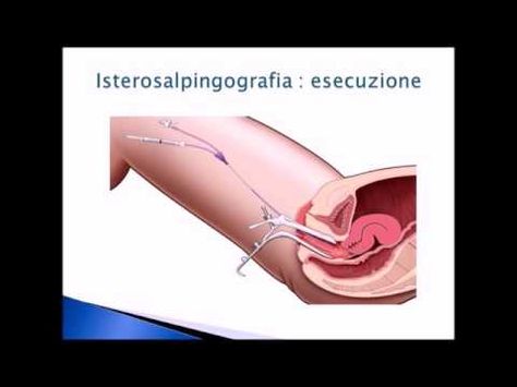 infezione prostata e fertility supplements