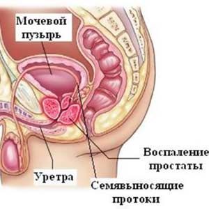 Receptek gyógynövények prostatitis zozh