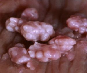 Pa midget mintos 7mm breast lump size