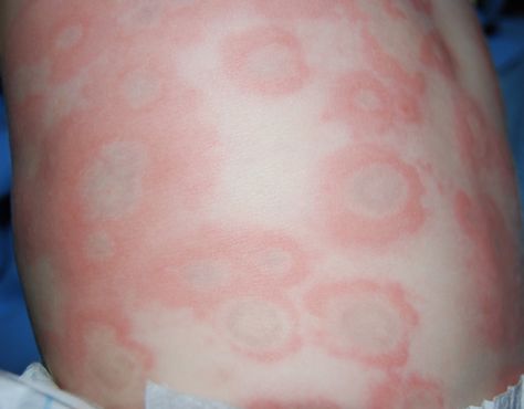 Ear infection hives stomach ms
