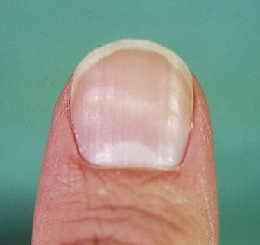 9 Best Damagednail Images On Pinterest Pitted Nails Fingernail 9 Best Damagednail Images On Pinterest Pitted Nails Fingernail Ridges And Vertical Nail