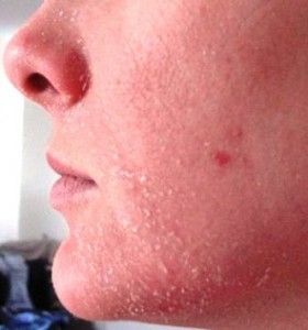 Red Dry Irritated Skin On The Face Red Dry Irritated Skin On The Face