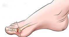 Totul despre artrita: tipuri, simptome, diagnostic, tratament