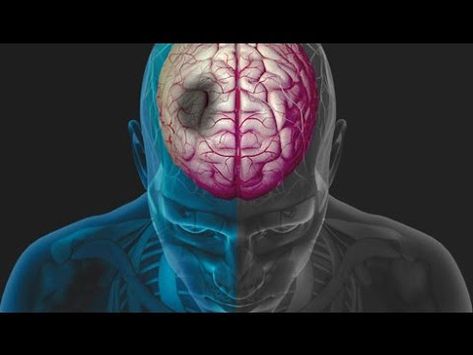 Hemorragia cerebral vs infarto