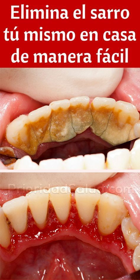 Como eliminar el calculo dental en casa