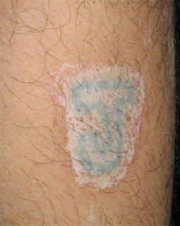 Http Kimyasalpeelingnedir Blogspot Com Tr Panosundaki Pin Http Kimyasalpeelingnedir Blogspot Com Tr Panosundaki Pin