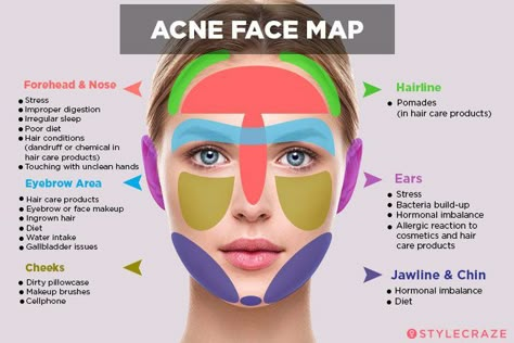 Face Mapping: Can You Use It to Improve Your Skin's Health? Face Acne, Acne Skin, Body Acne, Jawline Acne, Facial Acne Map, Body Skin, Facial Skin, Skin Tips, Skin Care Tips