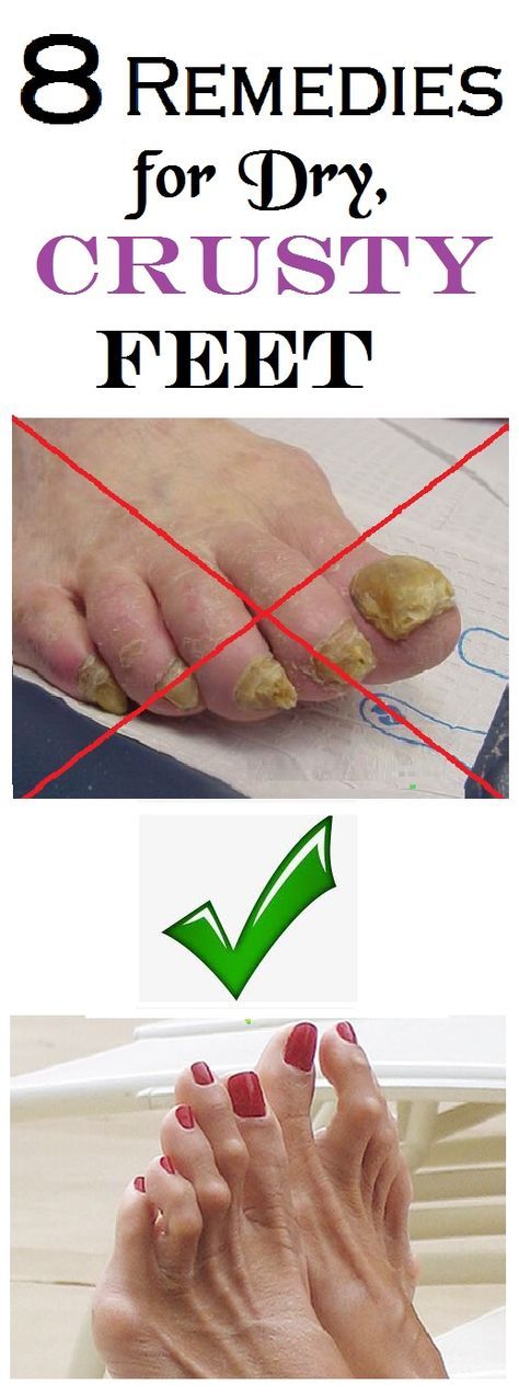home remedies for severely dry cracked feet