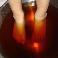 vindeca varicele severe