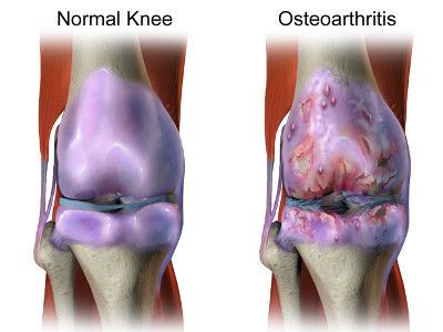 Osteoarthritis neck symptoms